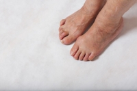 Hammertoe and Why Women Are More at Risk