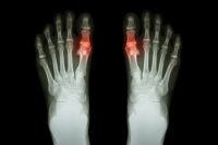What to Do About Gout