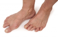 Symptoms and Affected Joints of Rheumatoid Arthritis in the Feet